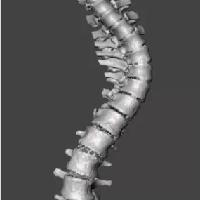 Scoliosis Spine Bone 3d model